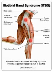 iliotibial-band-syndrome.jpg